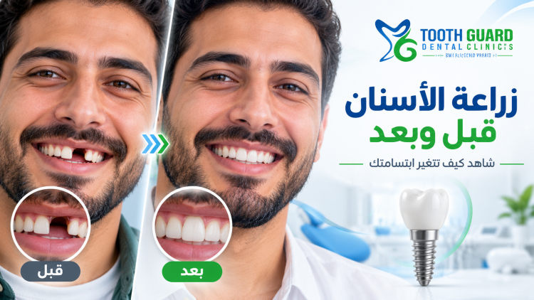 زراعة الأسنان قبل وبعد: شاهد كيف تتغير ابتسامتك للأفضل الآن